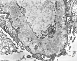 F,49y. | membranous glomerulopathy